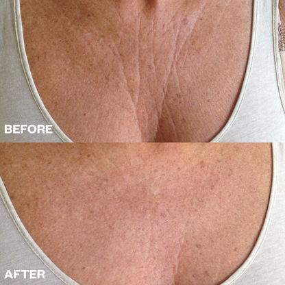 Chest Wrinkle Patch